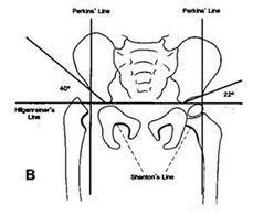 subluxarea congenitală a tratamentului articulației șoldului)